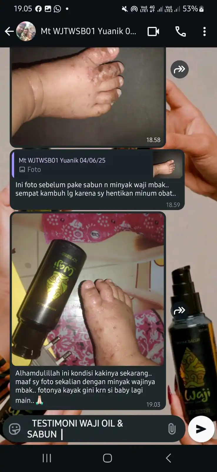 (MS)BINTIK BERAIR BAYI USIA 9Bulan (1)